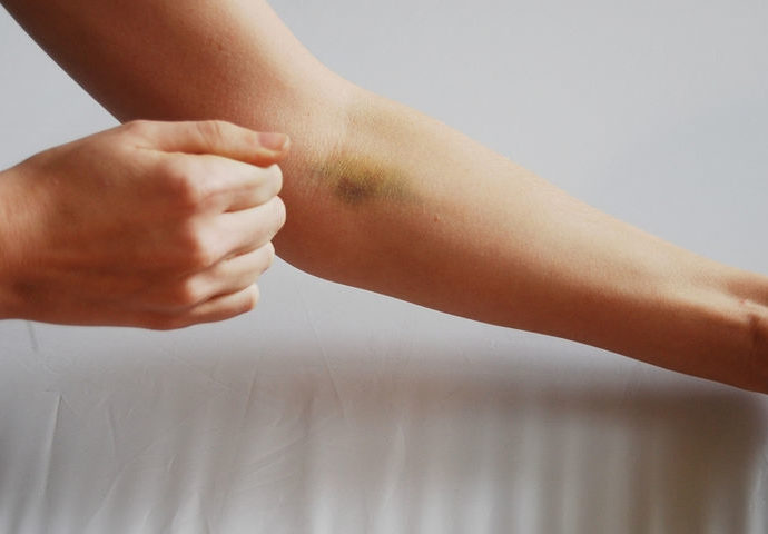 Λύση για μελανιά